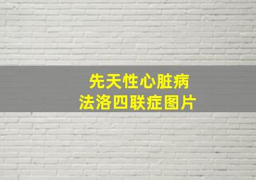 先天性心脏病法洛四联症图片