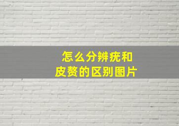 怎么分辨疣和皮赘的区别图片