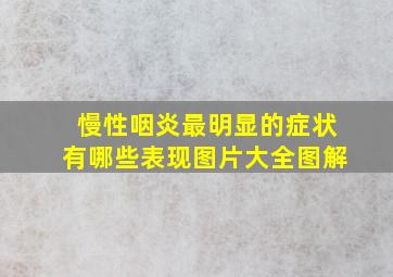 慢性咽炎最明显的症状有哪些表现图片大全图解