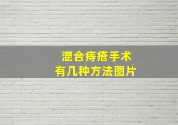 混合痔疮手术有几种方法图片