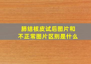 肺结核皮试后图片和不正常图片区别是什么