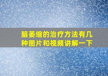 脑萎缩的治疗方法有几种图片和视频讲解一下