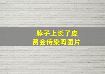 脖子上长了皮赘会传染吗图片