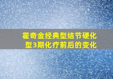 霍奇金经典型结节硬化型3期化疗前后的变化