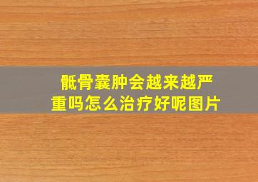 骶骨囊肿会越来越严重吗怎么治疗好呢图片