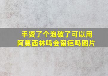 手烫了个泡破了可以用阿莫西林吗会留疤吗图片